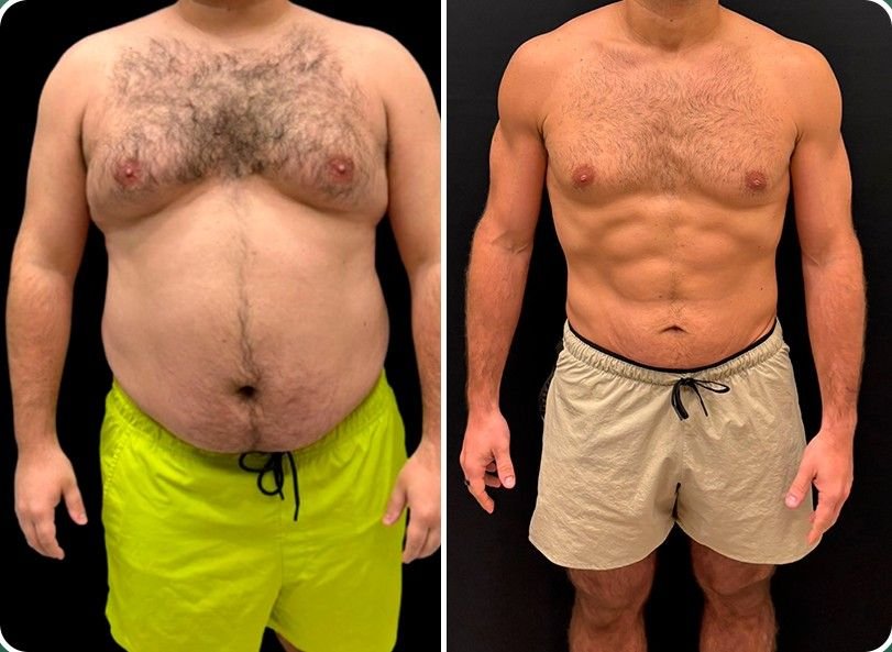 Paciente antes e depois do protocolo da Clínica Woitas