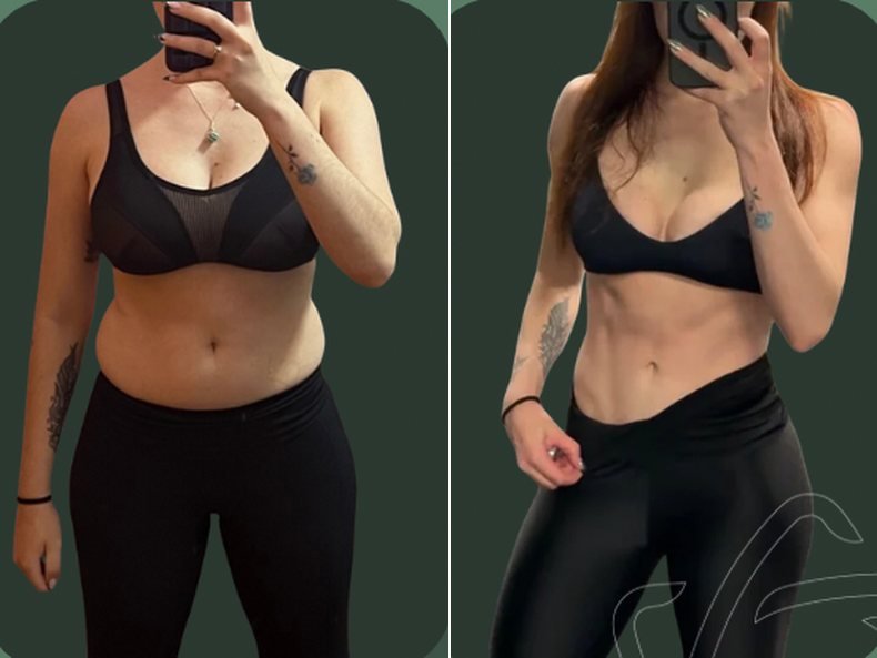 Paciente antes e depois do protocolo da Clínica Woitas